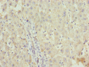 Immunohistochemistry of paraffin-embedded human liver cancer using CSB-PA026613ESR1HU at dilution of 1:100