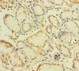 Immunohistochemistry of paraffin-embedded human gastric cancer using CSB-PA026619LA01HU at dilution of 1:100