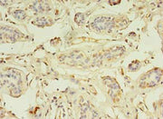 Immunohistochemistry of paraffin-embedded human breast cancer using CSB-PA026623LA01HU at dilution of 1:100