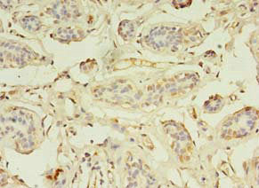 Immunohistochemistry of paraffin-embedded human breast cancer using CSB-PA026623LA01HU at dilution of 1:100