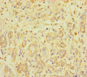 Immunohistochemistry of paraffin-embedded human pancreatic cancer using CSB-PA026644LA01HU at dilution of 1:100