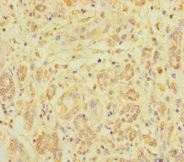 Immunohistochemistry of paraffin-embedded human pancreatic cancer using CSB-PA026644LA01HU at dilution of 1:100