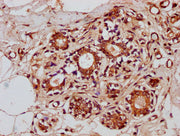 IHC image of CSB-PA026651LA01HU diluted at 1:300 and staining in paraffin-embedded human breast cancer performed on a Leica BondTM system. After dewaxing and hydration, antigen retrieval was mediated by high pressure in a citrate buffer (pH 6.0)....
