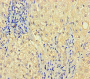 Immunohistochemistry of paraffin-embedded human liver cancer using CSB-PA026724LA01HU at dilution of 1:100