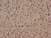 IHC image of CSB-PA026738OA01HU diluted at 1:100 and staining in paraffin-embedded human glioma performed on a Leica BondTM system. After dewaxing and hydration, antigen retrieval was mediated by high pressure in a citrate buffer (pH 6.0). Section...