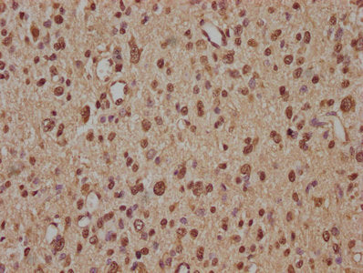 IHC image of CSB-PA026738OA01HU diluted at 1:100 and staining in paraffin-embedded human glioma performed on a Leica BondTM system. After dewaxing and hydration, antigen retrieval was mediated by high pressure in a citrate buffer (pH 6.0). Section...