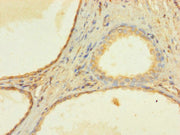 Immunohistochemistry of paraffin-embedded human prostate cancer using CSB-PA026746LA01HU at dilution of 1:100