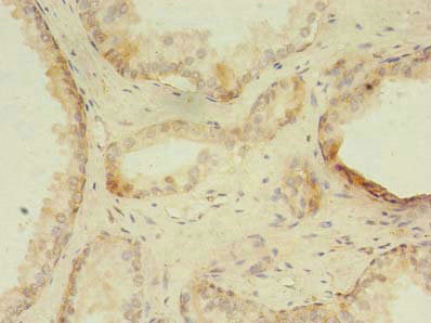 Immunohistochemistry of paraffin-embedded human prostate cancer using CSB-PA026795LA01HU at dilution of 1:100