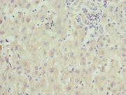 Immunohistochemistry of paraffin-embedded human liver cancer using CSB-PA026826ESR2HU at dilution of 1:100