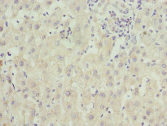 Immunohistochemistry of paraffin-embedded human liver cancer using CSB-PA026826ESR2HU at dilution of 1:100