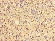 Immunohistochemistry of paraffin-embedded human glioma using CSB-PA026839LA01HU at dilution of 1:100