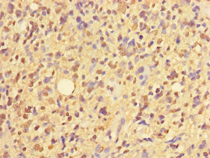 Immunohistochemistry of paraffin-embedded human glioma using CSB-PA026839LA01HU at dilution of 1:100