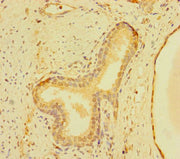 Immunohistochemistry of paraffin-embedded human prostate cancer using CSB-PA026841LA01HU at dilution of 1:100