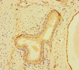 Immunohistochemistry of paraffin-embedded human prostate cancer using CSB-PA026841LA01HU at dilution of 1:100