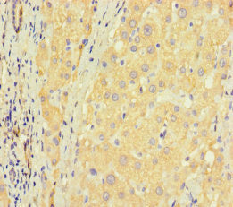 Immunohistochemistry of paraffin-embedded human liver cancer using CSB-PA026865LA01HU at dilution of 1:100