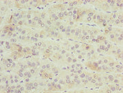 Immunohistochemistry of paraffin-embedded human liver cancer using CSB-PA026900LA01HU at dilution of 1:100