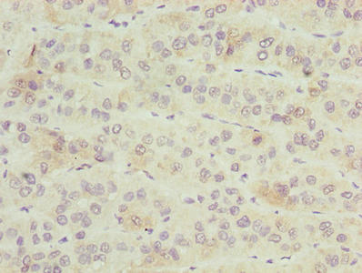Immunohistochemistry of paraffin-embedded human liver cancer using CSB-PA026900LA01HU at dilution of 1:100