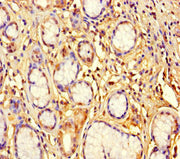 Immunohistochemistry of paraffin-embedded human gastric cancer using CSB-PA026905LA01HU at dilution of 1:100