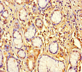 Immunohistochemistry of paraffin-embedded human gastric cancer using CSB-PA026905LA01HU at dilution of 1:100
