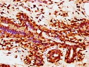IHC image of CSB-PA026914LA01HU diluted at 1:200 and staining in paraffin-embedded human breast cancer performed on a Leica BondTM system. After dewaxing and hydration, antigen retrieval was mediated by high pressure in a citrate buffer (pH 6.0)....