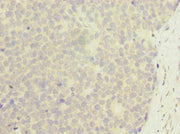 Immunohistochemistry of paraffin-embedded human gastric cancer using CSB-PA026952LA01HU at dilution of 1:100