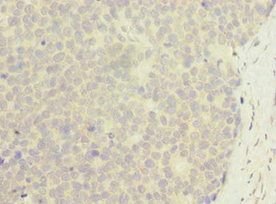 Immunohistochemistry of paraffin-embedded human gastric cancer using CSB-PA026952LA01HU at dilution of 1:100