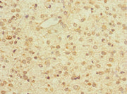 Immunohistochemistry of paraffin-embedded human glioma using CSB-PA027030LA01HU at dilution of 1:100