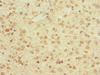 Immunohistochemistry of paraffin-embedded human glioma using CSB-PA027030LA01HU at dilution of 1:100