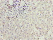 Immunohistochemistry of paraffin-embedded human liver cancer using CSB-PA027041ESR1HU at dilution of 1:100