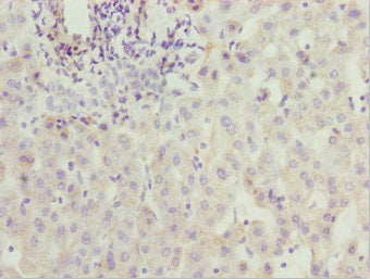 Immunohistochemistry of paraffin-embedded human liver cancer using CSB-PA027041ESR1HU at dilution of 1:100