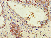 Immunohistochemistry of paraffin-embedded human prostate cancer using CSB-PA027086LA01HU at dilution of 1:100