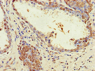 Immunohistochemistry of paraffin-embedded human prostate cancer using CSB-PA027086LA01HU at dilution of 1:100