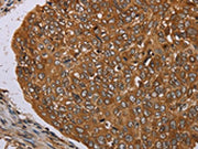 The image on the left is immunohistochemistry of paraffin-embedded Human esophagus cancer tissue using CSB-PA027525(PIM3 Antibody) at dilution 1/35, on the right is treated with synthetic peptide. (Original magnification: ×200)