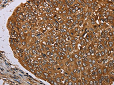 The image on the left is immunohistochemistry of paraffin-embedded Human esophagus cancer tissue using CSB-PA027525(PIM3 Antibody) at dilution 1/35, on the right is treated with synthetic peptide. (Original magnification: ×200)