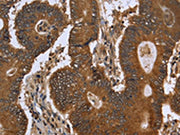 The image on the left is immunohistochemistry of paraffin-embedded Human colon cancer tissue using CSB-PA028033(FGFRL1 Antibody) at dilution 1/40, on the right is treated with fusion protein. (Original magnification: ×200)