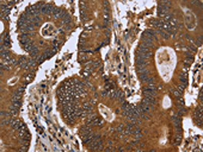 The image on the left is immunohistochemistry of paraffin-embedded Human colon cancer tissue using CSB-PA028033(FGFRL1 Antibody) at dilution 1/40, on the right is treated with fusion protein. (Original magnification: ×200)