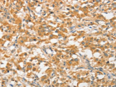 The image on the left is immunohistochemistry of paraffin-embedded Human thyroid cancer tissue using CSB-PA028037(ATG5 Antibody) at dilution 1/40, on the right is treated with fusion protein. (Original magnification: ×200)