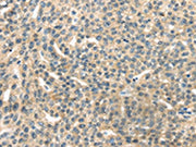 The image on the left is immunohistochemistry of paraffin-embedded Human esophagus cancer tissue using CSB-PA028193(RASA2 Antibody) at dilution 1/45, on the right is treated with synthetic peptide. (Original magnification: ×200)