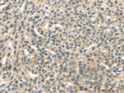 The image on the left is immunohistochemistry of paraffin-embedded Human esophagus cancer tissue using CSB-PA028193(RASA2 Antibody) at dilution 1/45, on the right is treated with synthetic peptide. (Original magnification: ×200)