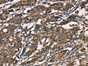 The image on the left is immunohistochemistry of paraffin-embedded Human gastic cancer tissue using CSB-PA028431(SENP1 Antibody) at dilution 1/40, on the right is treated with synthetic peptide. (Original magnification: ×200)