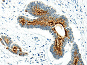 The image on the left is immunohistochemistry of paraffin-embedded Human colorectal cancer tissue using CSB-PA028760(WWOX Antibody) at dilution 1/20, on the right is treated with synthetic peptide. (Original magnification: ×200)