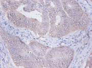 Immunohistochemistry of paraffin-embedded human colon cancer using CSB-PA02925A0Rb at dilution of 1:100