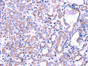 The image on the left is immunohistochemistry of paraffin-embedded Human thyroid cancer tissue using CSB-PA029300(SRPK1 Antibody) at dilution 1/35, on the right is treated with fusion protein. (Original magnification: ×200)