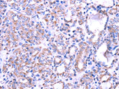 The image on the left is immunohistochemistry of paraffin-embedded Human thyroid cancer tissue using CSB-PA029300(SRPK1 Antibody) at dilution 1/35, on the right is treated with fusion protein. (Original magnification: ×200)