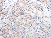 The image on the left is immunohistochemistry of paraffin-embedded Human lung cancer tissue using CSB-PA029613(MMP11 Antibody) at dilution 1/40, on the right is treated with synthetic peptide. (Original magnification: ×200)