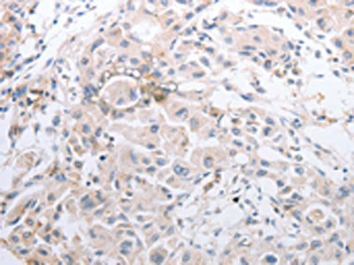 The image on the left is immunohistochemistry of paraffin-embedded Human lung cancer tissue using CSB-PA029613(MMP11 Antibody) at dilution 1/40, on the right is treated with synthetic peptide. (Original magnification: ×200)