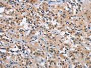 The image on the left is immunohistochemistry of paraffin-embedded Human thyroid cancer tissue using CSB-PA029620(MAPT Antibody) at dilution 1/40, on the right is treated with synthetic peptide. (Original magnification: ×200)