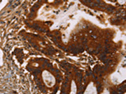 The image on the left is immunohistochemistry of paraffin-embedded Human colon cancer tissue using CSB-PA029827(GPA33 Antibody) at dilution 1/30, on the right is treated with fusion protein. (Original magnification: ×200)