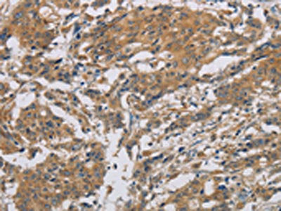 The image is immunohistochemistry of paraffin-embedded Human gastic cancer tissue using CSB-PA029843(ARF6 Antibody) at dilution 1/20. (Original magnification: ×200)
