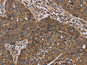 The image on the left is immunohistochemistry of paraffin-embedded Human lung cancer tissue using CSB-PA029863(OXTR Antibody) at dilution 1/40, on the right is treated with synthetic peptide. (Original magnification: ×200)
